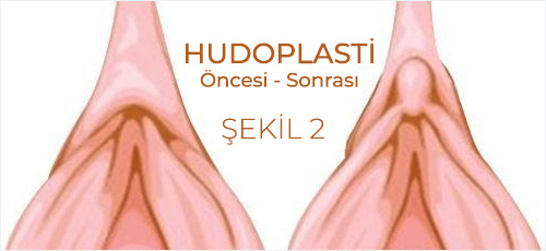 Hudoplasti Öncesi ve Sonrası Görüntü