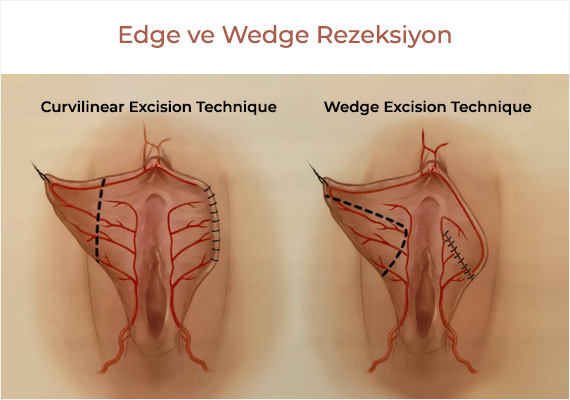 Labioplasti teknikleri: Edge Rezeksiyon ve Wedge Rezeksiyon