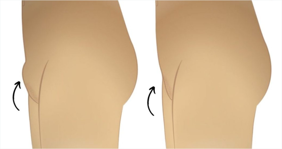 Mons Pubis Estetiği Öncesi ve Sonrası