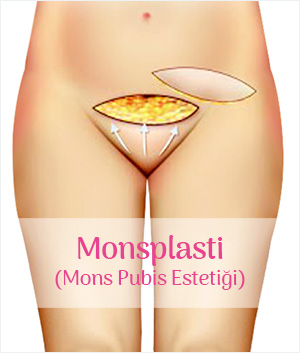 Monsplasti (Mons Pubis Estetiği)